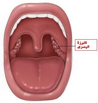 tonsils (1)